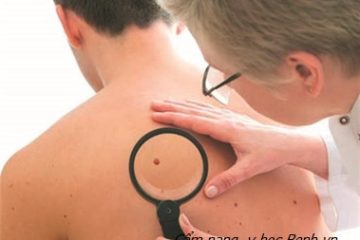 Những biểu hiện ‘tố’ các giai đoạn ung thư da bạn nên biết Những biểu hiện ‘tố’ các giai đoạn ung thư da bạn nên biết