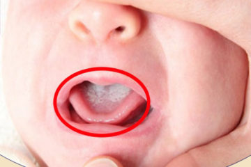 Cách khắc phục bệnh tưa lưỡi ở trẻ