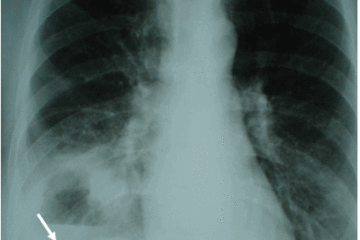 Hướng dẫn điều trị áp xe màng phổi của Bộ y tế