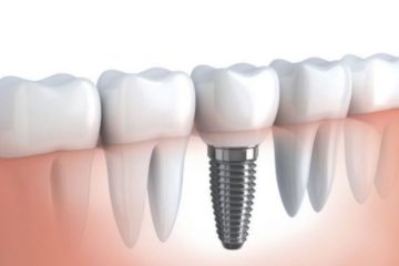 Một số lưu ý khi trồng răng implant