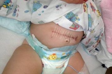 Lạ kỳ bé gái 10 ngày tuổi bị ung thư buồng trứng