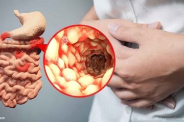 Các phương pháp điều trị bệnh Crohn