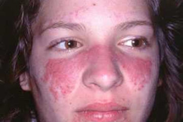Bệnh Lupus ban đỏ hệ thống