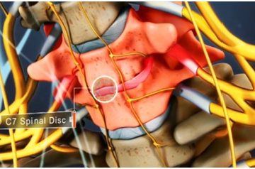Bệnh rễ tủy cổ và phương pháp điều trị nắn chỉnh cột sống