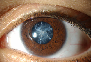 Nhận biết sớm các dấu hiệu gây bệnh ở mắt