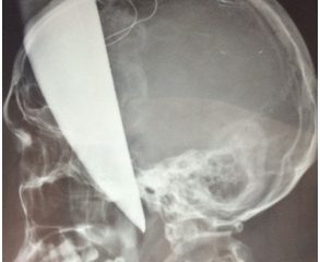 Bệnh viện Việt Đức cứu sống bệnh nhân bị dao bầu đâm xuyên hộp sọ