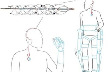 Công nghệ ‘cột sống bionic’ giúp người liệt có thể đi lại bình thường