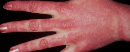 Bệnh viêm đa cơ - Dermatomyotis