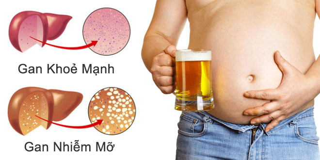 Gan nhiễm mỡ không do rượu ngày càng phổ biến và nguy hiểm - Benh.vn