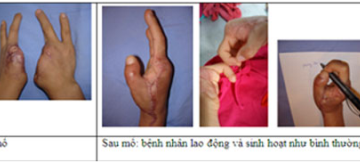 Đột phá: Kỹ thuật ghép ngón chân thành ngón tay cái