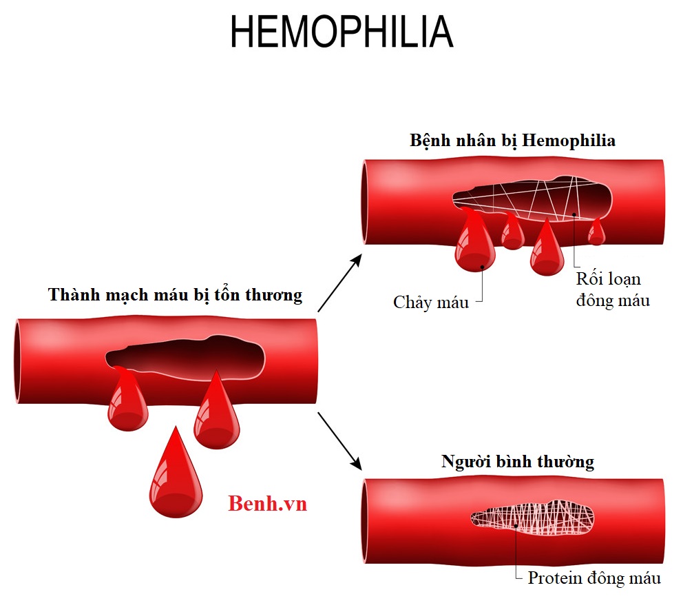 So sánh mạch máu bình thường và mạch máu bệnh nhân Hemophilia