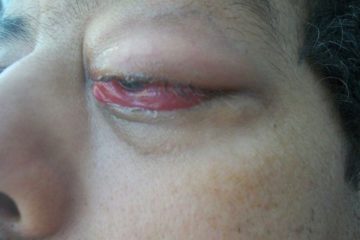 Điều trị bệnh viêm tổ chức hốc mắt Bộ Y tế ban hành