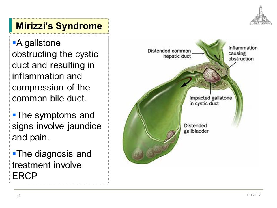 Hội chứng Mirizzi