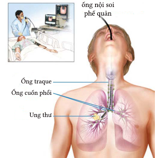 Kiểm tra ung thư phổi