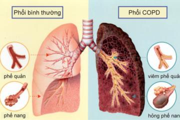 Triệu chứng bệnh lao phổi – những dấu hiệu lâm sàng và cận lâm sàng