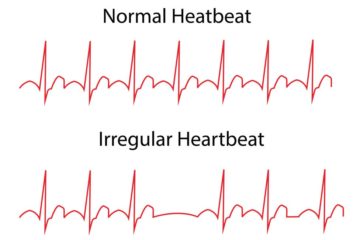 Hội chứng tiền kích thích trong rối loạn nhịp tim