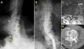 Chẩn đoán hình ảnh tổn thương cột sống do bệnh loãng xương