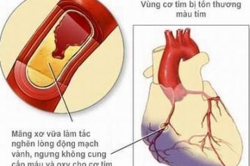 Thuốc điều trị nhồi máu cơ tim và những khuyến cáo