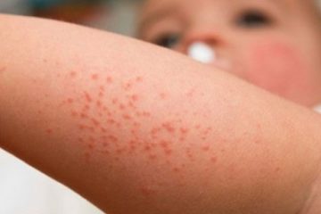 Những bệnh da có nguy cơ lây nhiễm cần cảnh giác