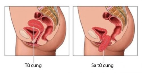 Các phòng tránh và điều trị bệnh sa dạ con - Benh.vn