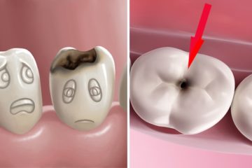 Phương pháp điều trị và phòng ngừa bệnh sâu răng