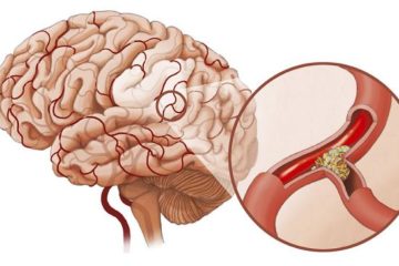 Cấp cứu đột quỵ não