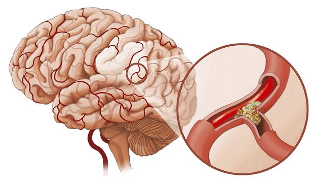 tai biến mạch máu não