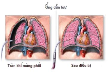 Tràn khí màng phổi