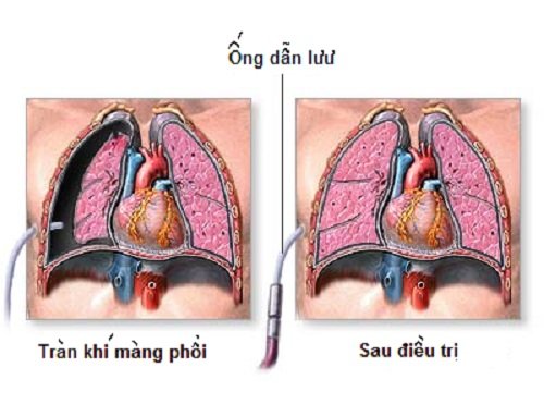 Tràn khí màng phổi - Benh.vn