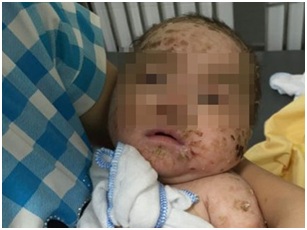 Cảnh báo: Trẻ bị nhiễm độc da do tắm lá chữa thủy đậu