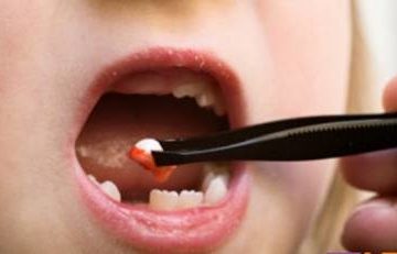Những điều cần biết trong thời điểm thay răng sữa cho trẻ