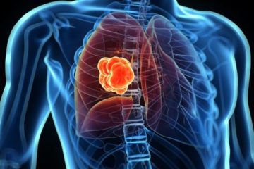 10 dấu hiệu cảnh báo sớm bệnh Ung thư phổi