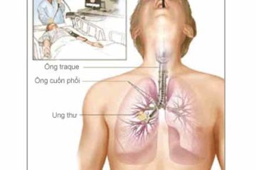 Những điều cần biết về ung thư phổi