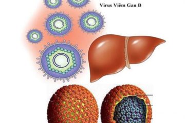 Bệnh viêm gan virus B cấp tính