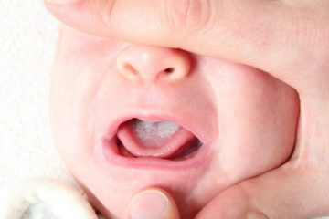 Bệnh viêm miệng ở trẻ mới sinh