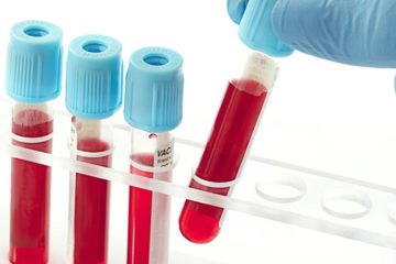Lợi ích và các cảnh báo bệnh của xét nghiệm canxi máu