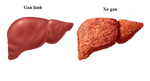 Xơ gan, xơ gan cổ trướng