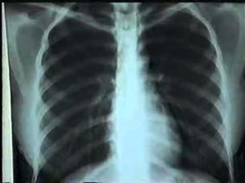 X- quang chẩn đoán bệnh phổi - Benh.vn