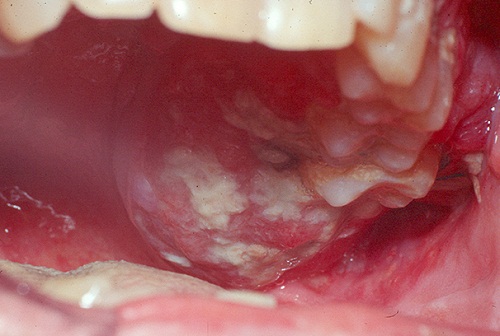 ung thư miệng