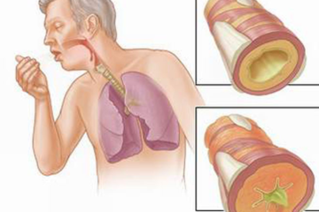 6 biến chứng nguy hiểm của bệnh hen suyễn