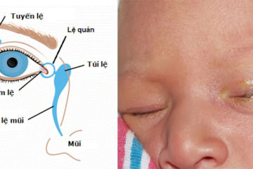 Dấu hiệu trẻ sơ sinh bị tắc tuyến lệ và phương pháp điều trị