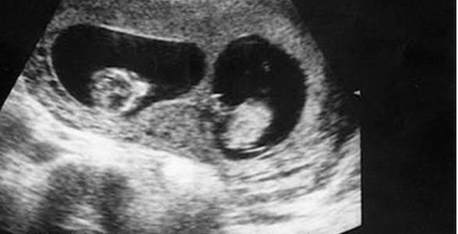 Siêu âm thai đôi: Cảm nhận niềm hạnh phúc đôi khi chặt chẽ hơn bao giờ hết với siêu âm thai đôi - kỹ thuật y tế được áp dụng để phát hiện và theo dõi sự phát triển của thai nhi song sinh. Hãy xem hình ảnh siêu âm thai đôi để khám phá thêm về những điều đặc biệt và thú vị của thai kỳ này.