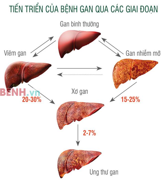 Bệnh xơ gan: nguyên nhân, triệu chứng, chẩn đoán, cách phòng và ...