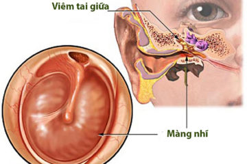 Viêm tai giữa: Nguyên nhân, triệu chứng và cách điều trị