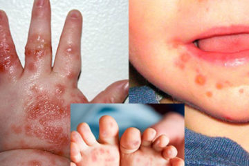Trẻ bị chân tay miệng và cách điều trị như thế nào?