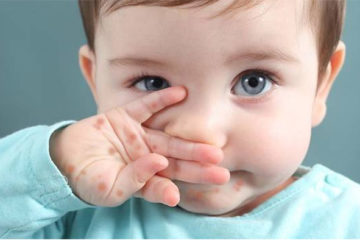 Dấu hiệu tay chân miệng ở trẻ sơ sinh và cách phòng bệnh