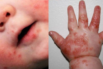 Điều trị bệnh chân tay miệng như thế nào ở trẻ em?