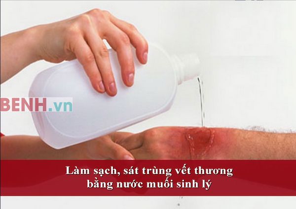 Su-dung-nuoc-muoi-sinh-ly-rua-vet-thuong-dung-cach-06_1479_1047