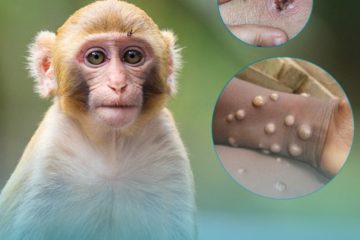 Hướng dẫn chẩn đoán, điều trị và phòng bệnh đậu mùa khỉ theo Bộ Y Tế