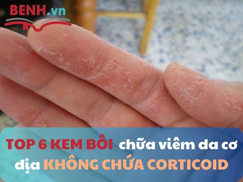 top-6-kem-boi-chua-viem-da-co-dia-o-tay-khong-chua-corticoid-1